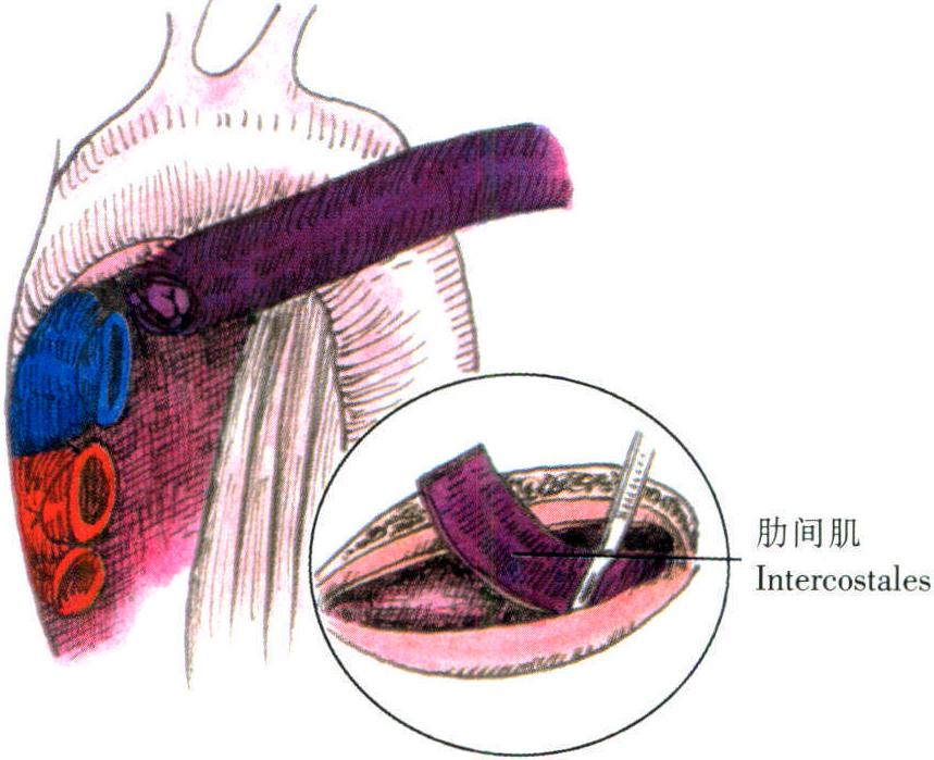 支氣管胸膜瘺修補術(shù)
